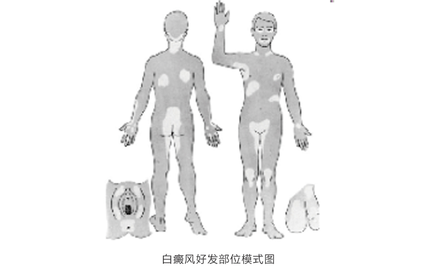 王宏偉教授專欄|白癜風相關知識科普(圖1) 王宏偉教授專欄|白癜風相關知識科普(圖1)